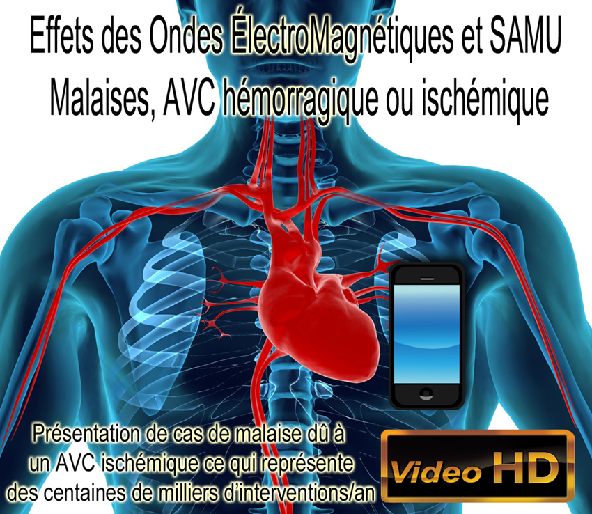 AVC_ischemique_presentation_de_cas_850.jpg