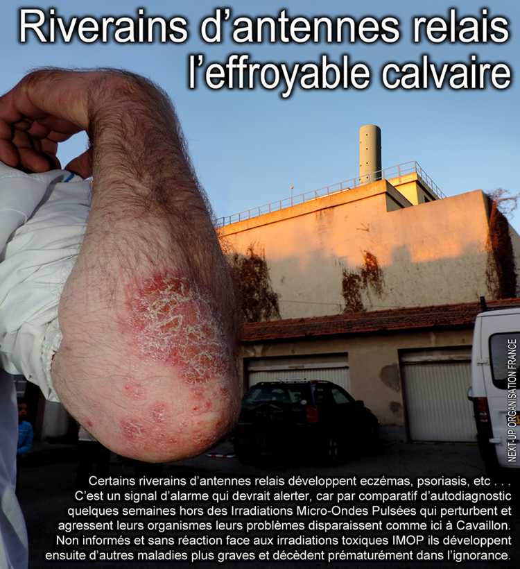 Antennes_relais_riverains_eczema_et_psoriasis_alerte_750_DSCN3979.jpg