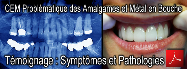 EHS_Temoignage_Symptomes_Pathologies_CEM_Problematique_Amalgames_et_metal_bouche_27_01_2012_news