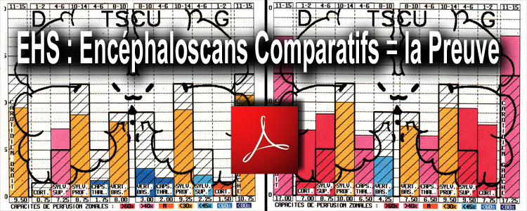 EHS_encephaloscans_comparatifs_la_preuve