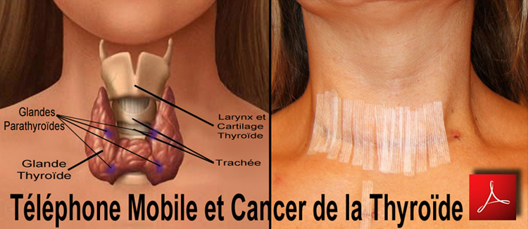 Etude_Scientifique_Telephone_mobile_et_cancer_thyroide_Pr_Raphael_Feinmesser_Flyer_750_11_03_2013