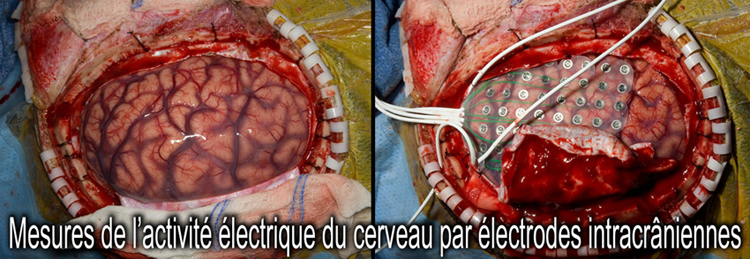 Mesures_activite_electrique_du_cerveau_par_electrodes_intracraniennes_750