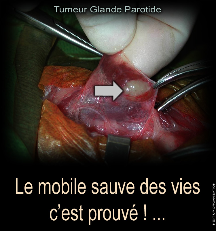 Posters_Sensibilisation_Le_Mobile_sauve_des_vies_c_est_prouve_Tumeur_Glande_Parotide_750
