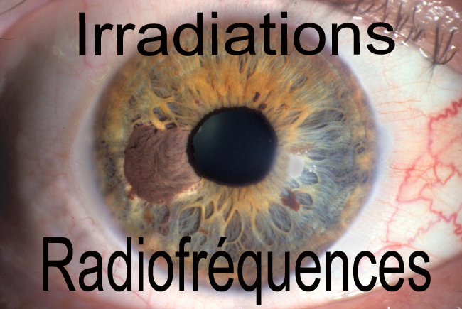 Next-up - Oeil CEM radiofréquences Eye EMF
